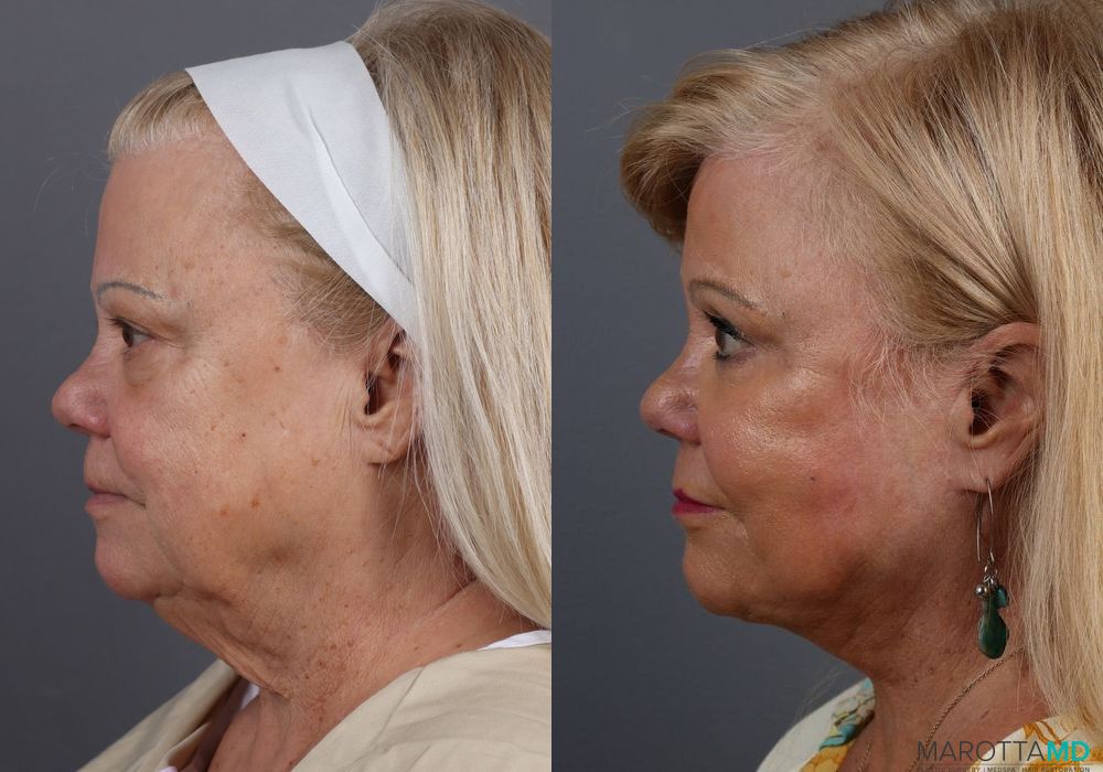 Before and after Blepharoplasty case 7127 - Angle 5