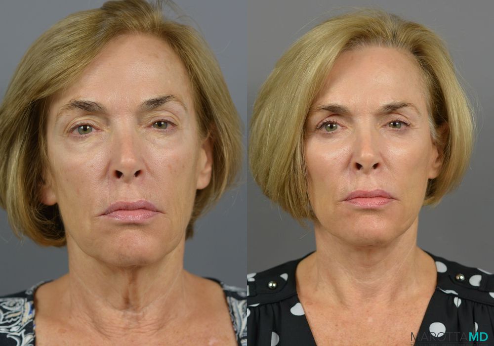 Blepharoplasty - Case 928