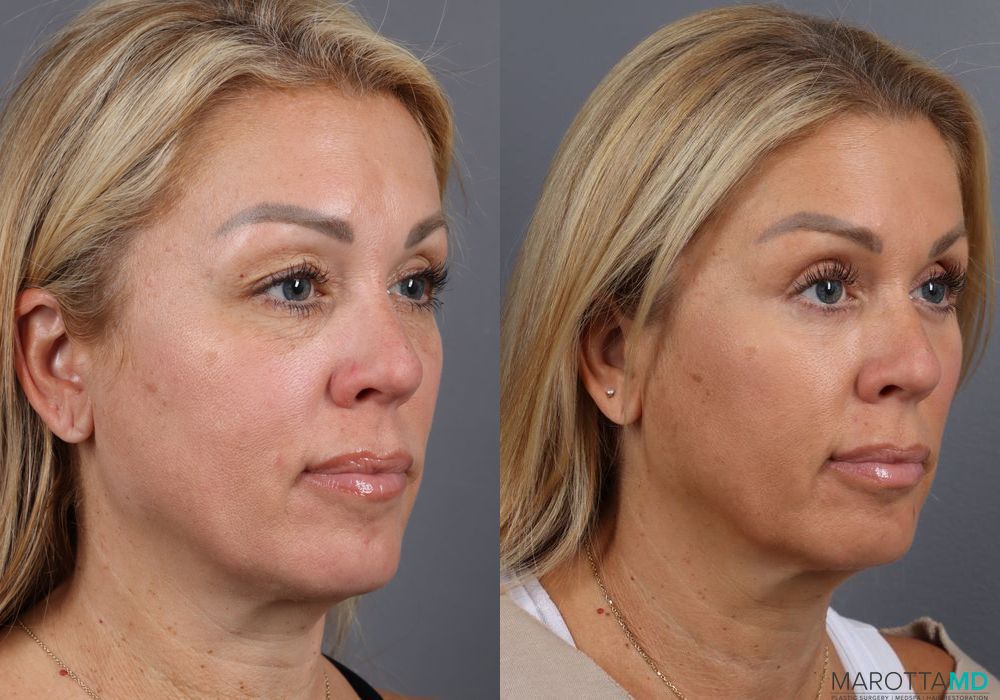 Blepharoplasty - Thumbnail 3