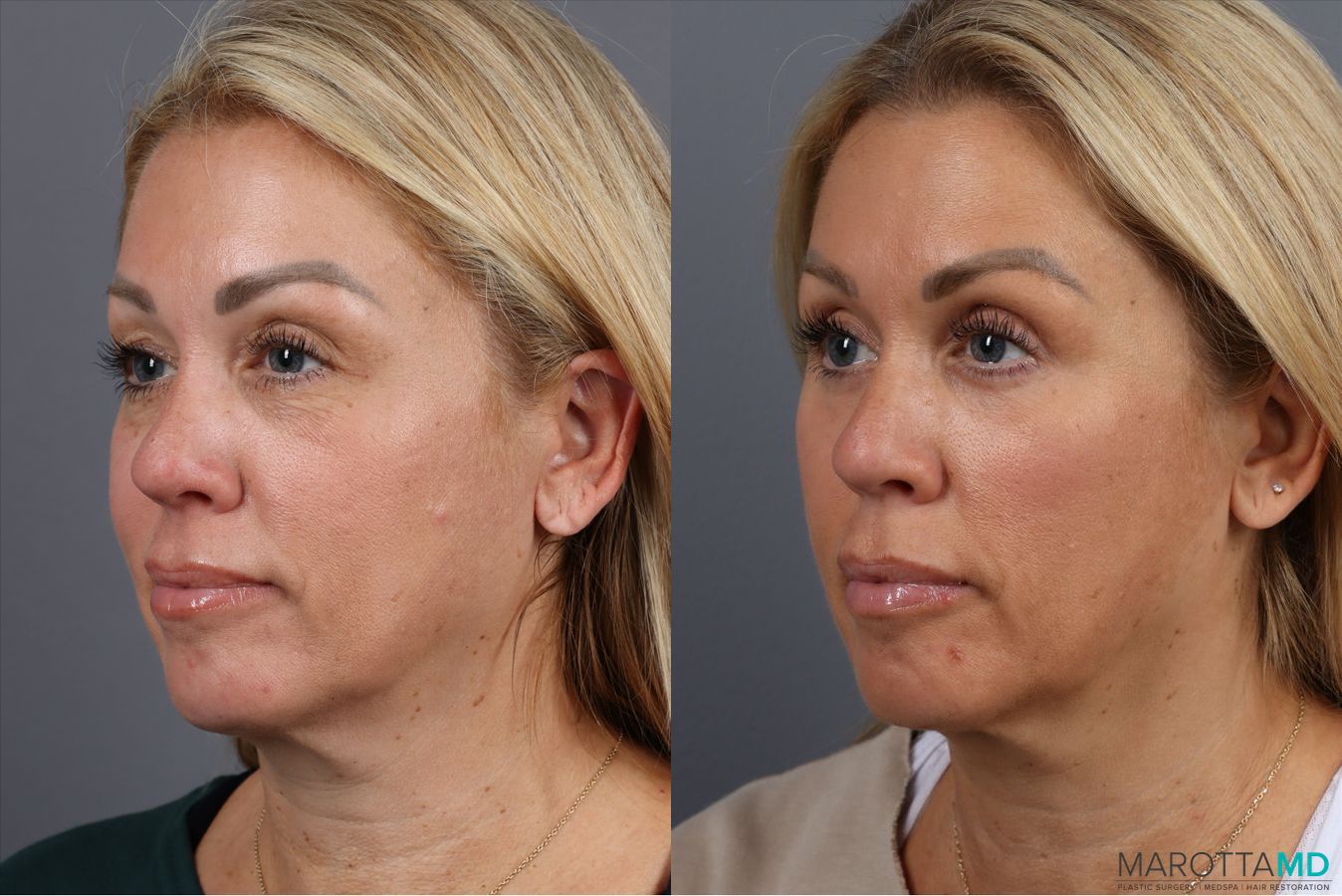 Before and after Blepharoplasty Upper case 41929 - Angle 3