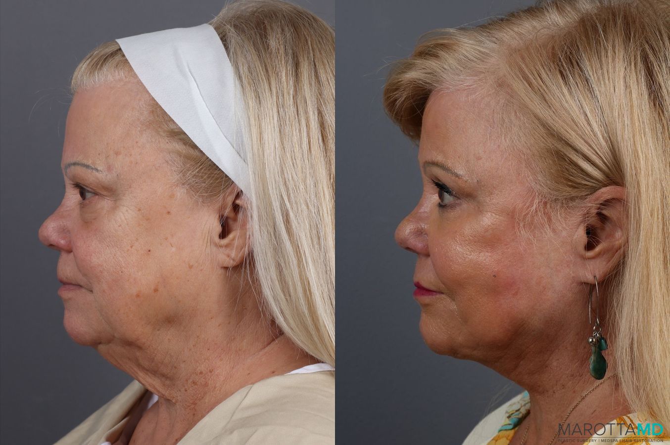 Before and after Blepharoplasty case 7127 - Angle 5