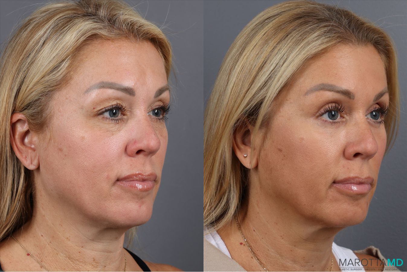 Before and after Blepharoplasty Upper case 41929 - Angle 2
