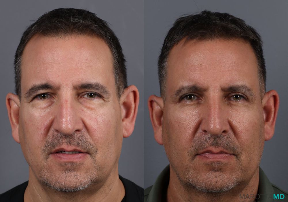 Blepharoplasty - Case 922