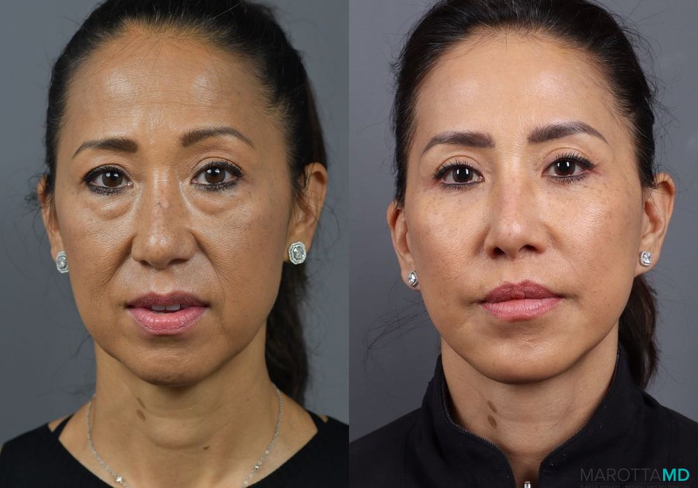 Blepharoplasty - Case 141