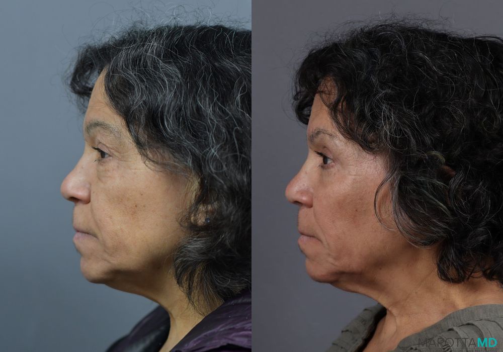 Blepharoplasty - Thumbnail 3