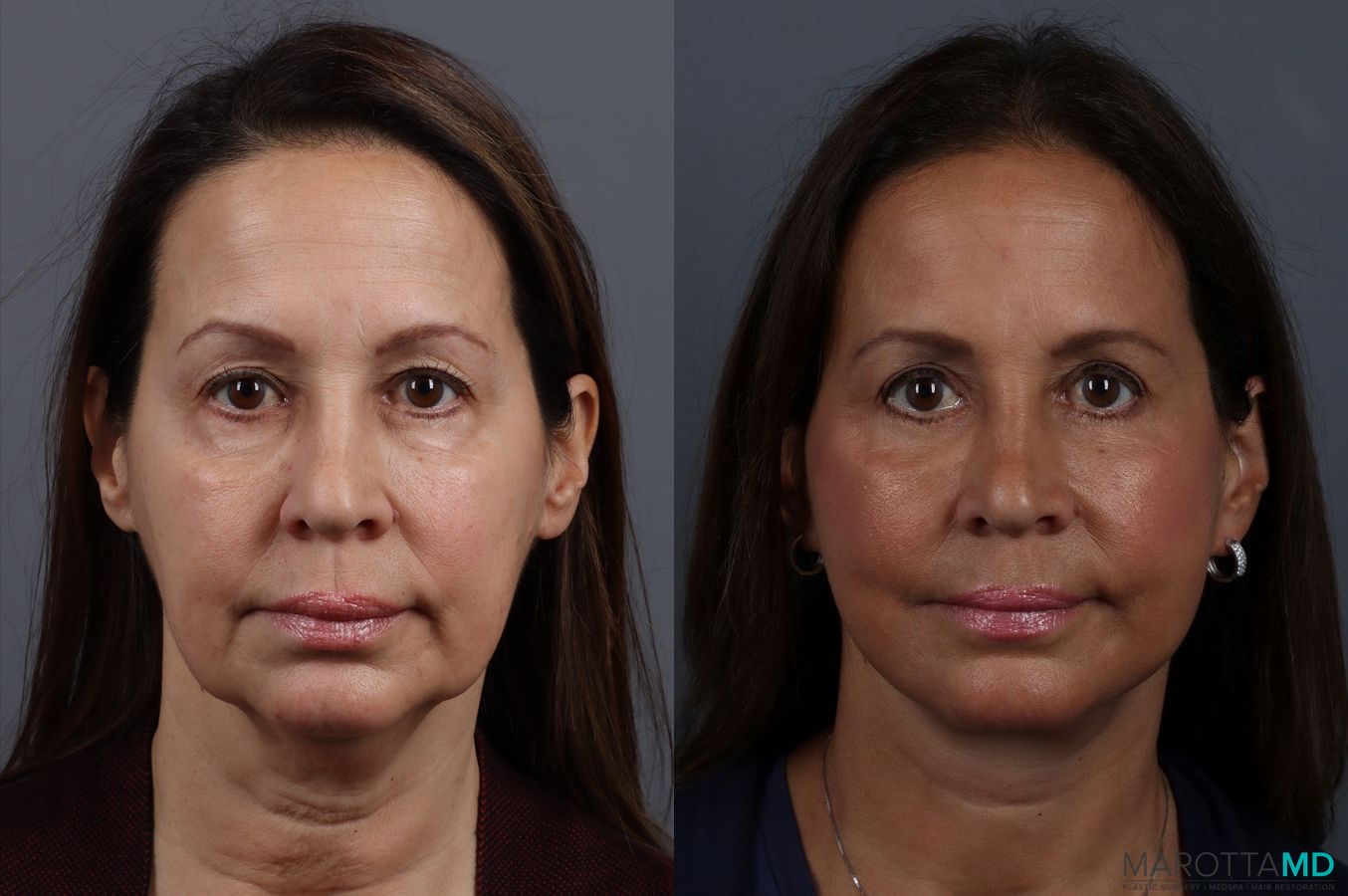 Before and after Blepharoplasty case 7096
