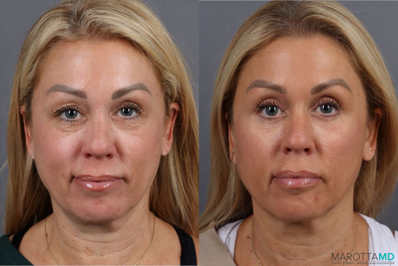 Before and after Blepharoplasty Upper case 41929