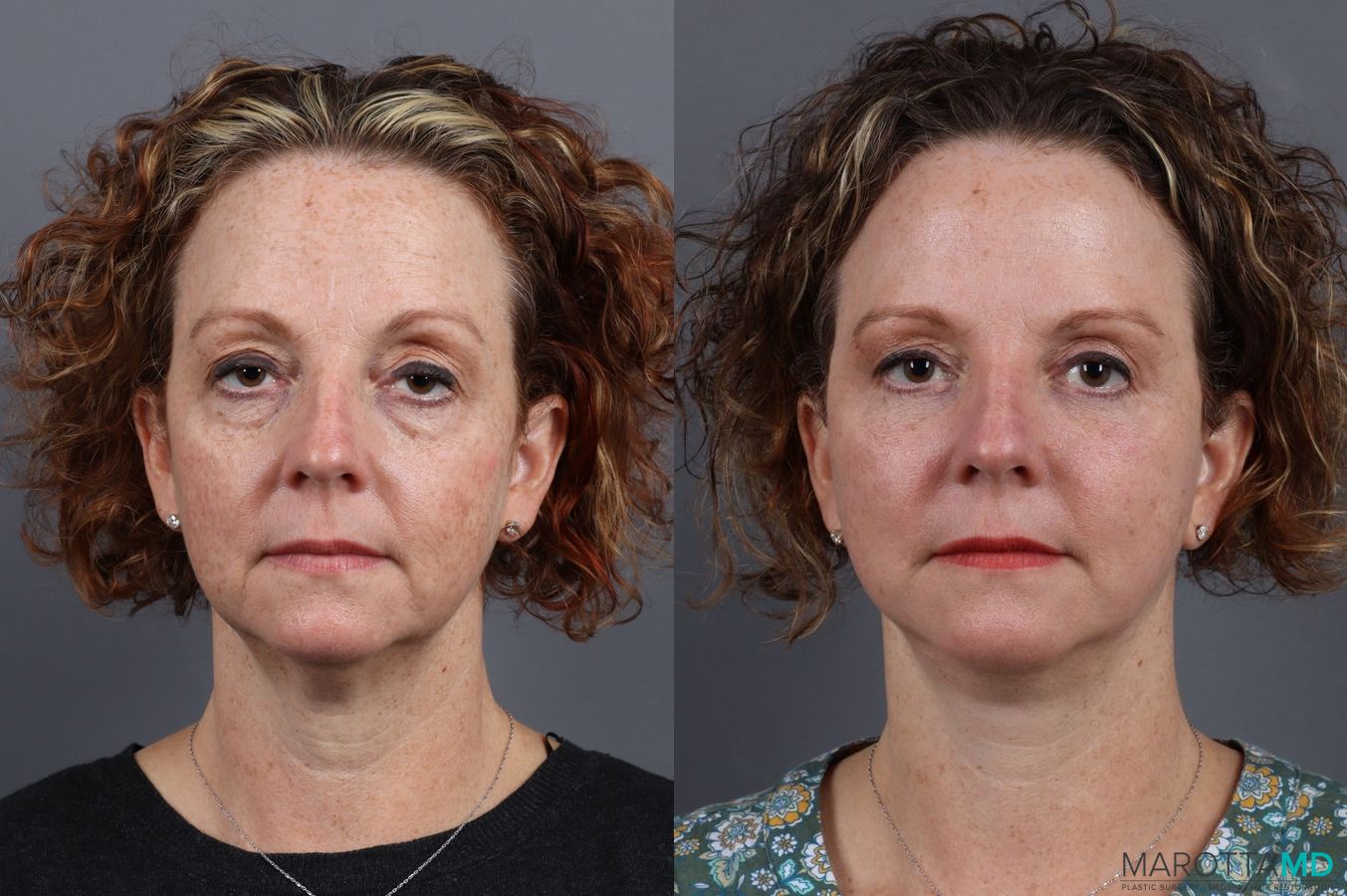 Before and after Blepharoplasty case 7084