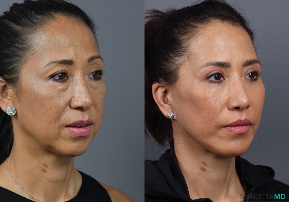 Blepharoplasty - Thumbnail 2