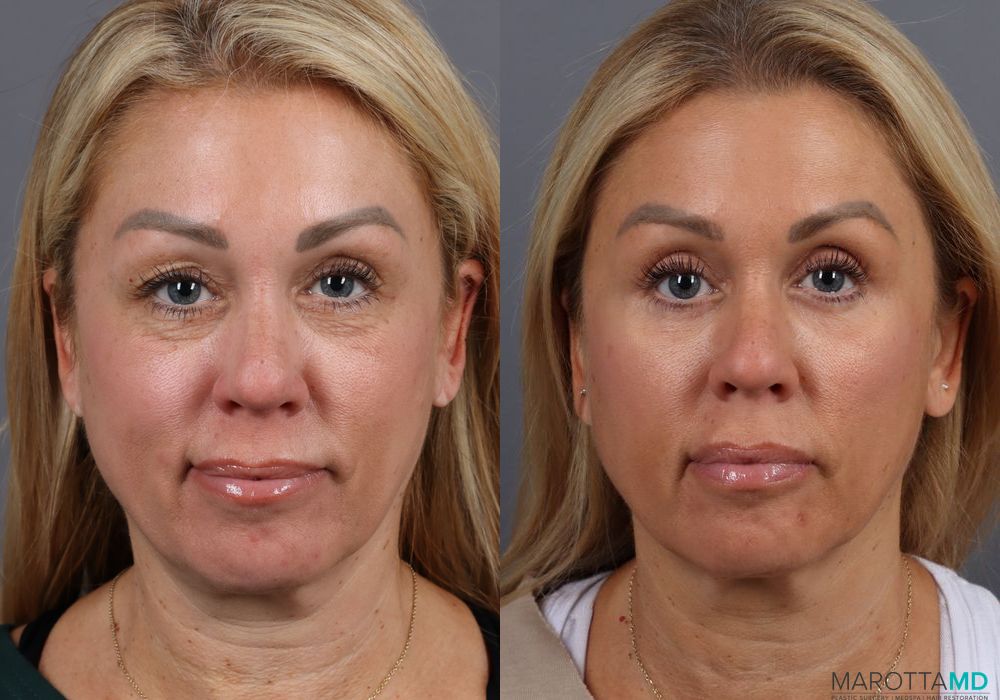 Blepharoplasty - Case 147