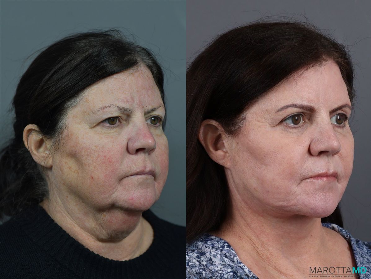 Before and after Blepharoplasty case 7078 - Angle 2