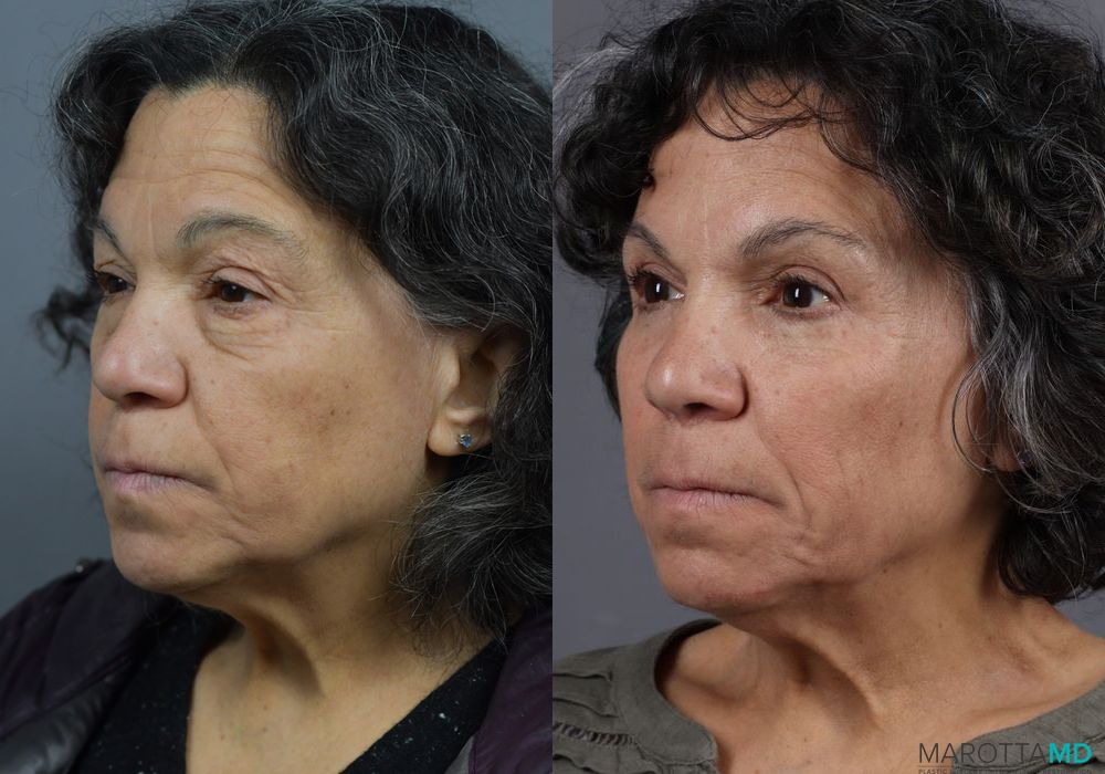 Blepharoplasty - Thumbnail 2