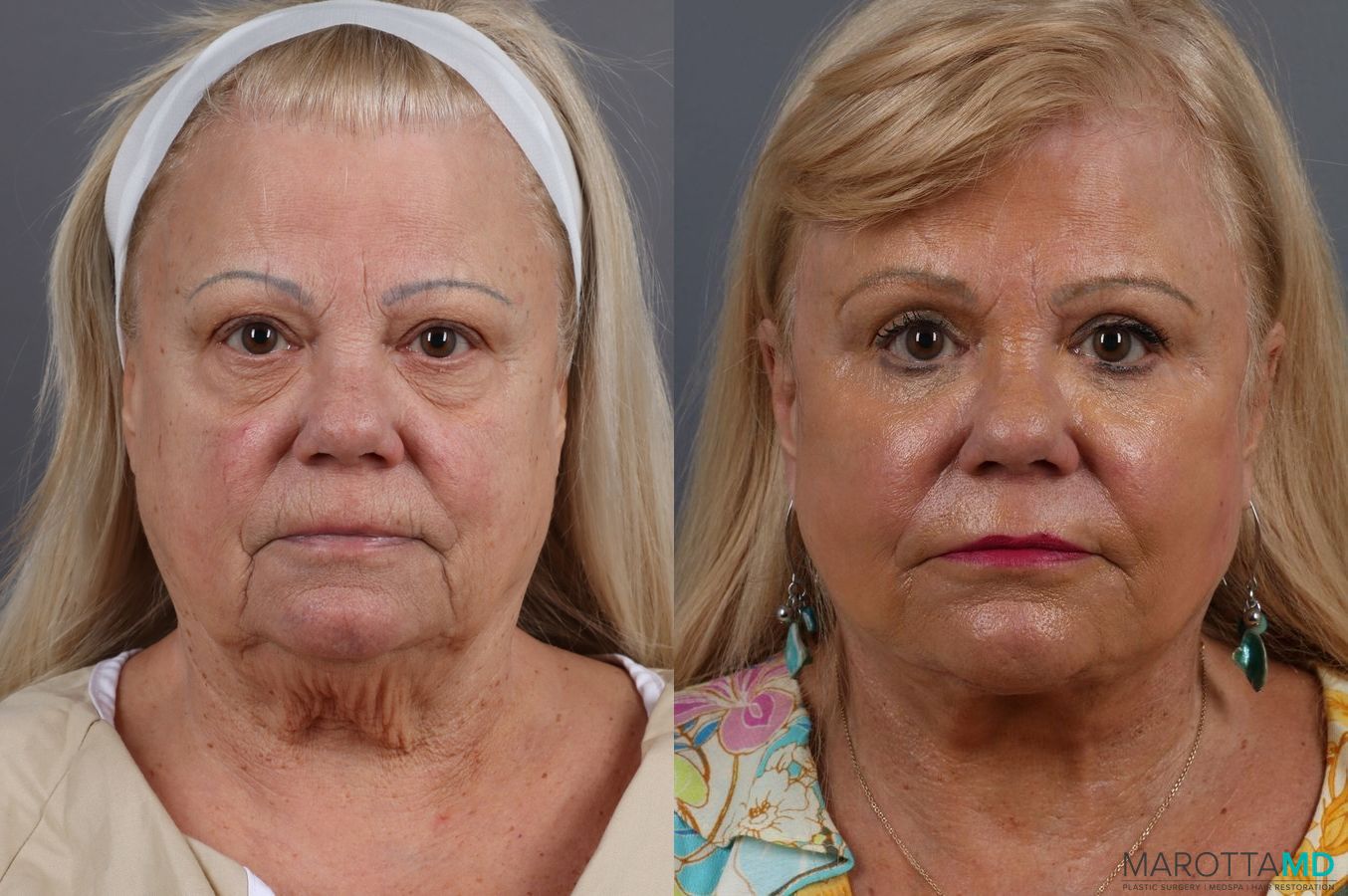 Before and after Blepharoplasty case 7127