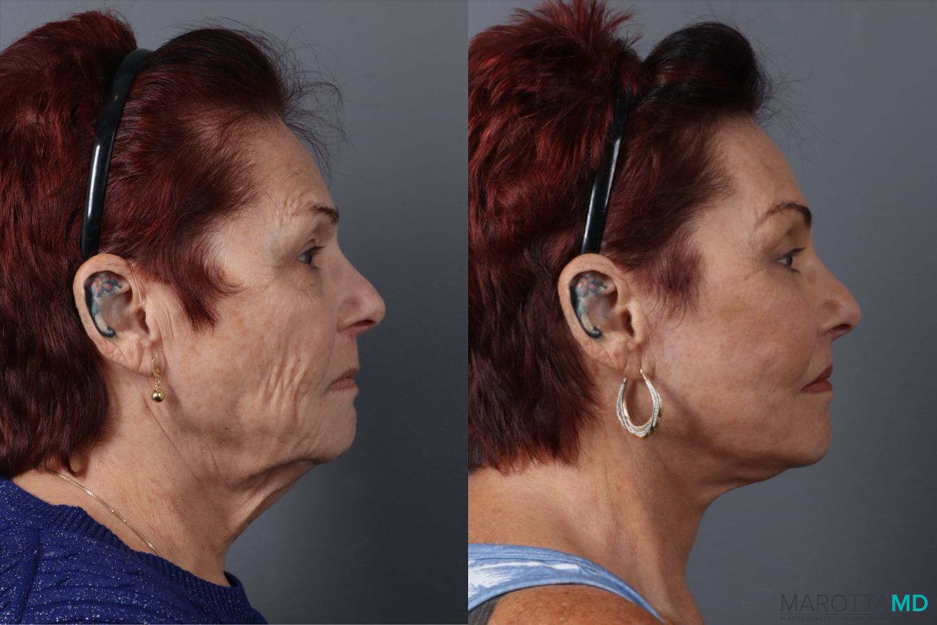 Before and after Blepharoplasty Lower case 49464 - Angle 3