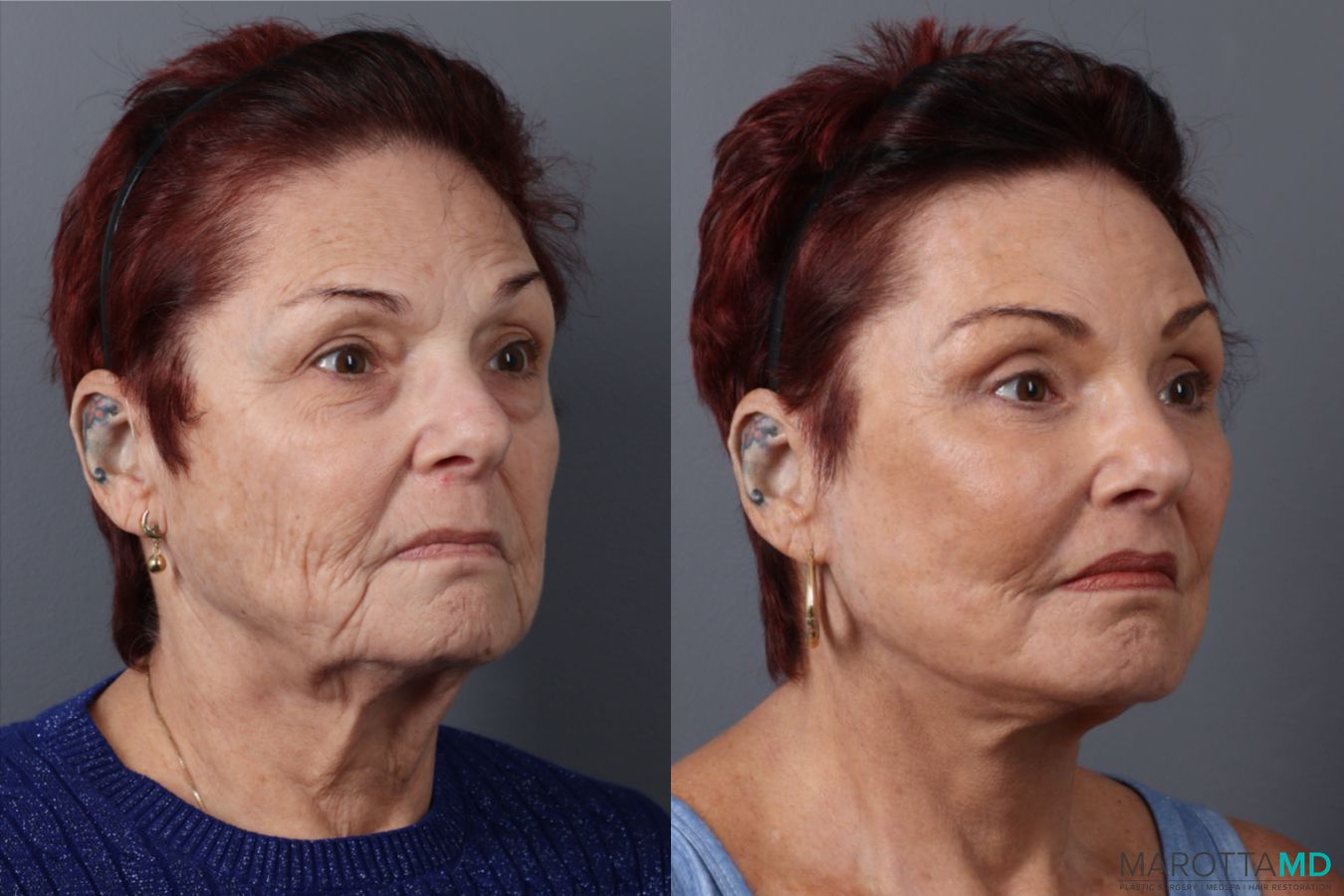 Before and after Blepharoplasty Lower case 49464 - Angle 2