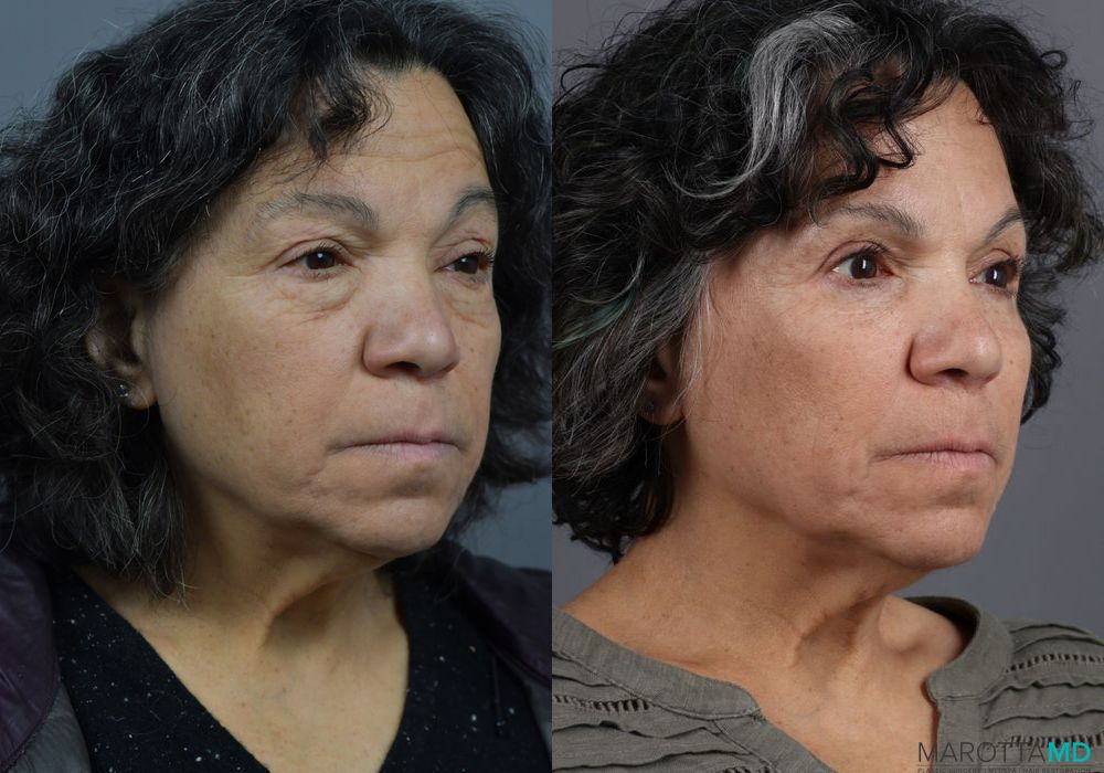 Blepharoplasty - Thumbnail 4