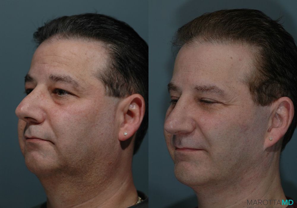 Blepharoplasty - Thumbnail 4