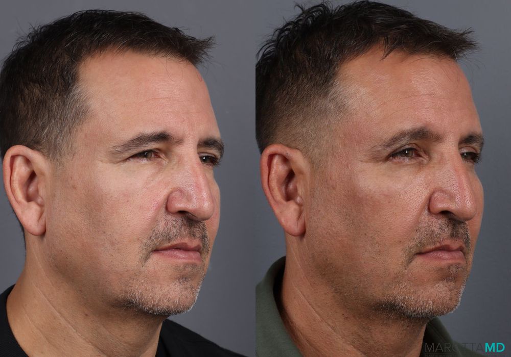 Blepharoplasty - Thumbnail 2