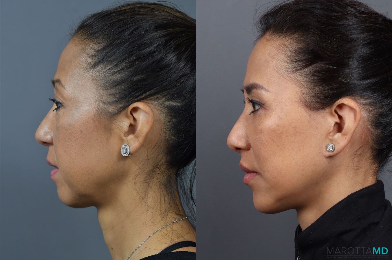 Before and after Blepharoplasty case 7025 - Angle 5