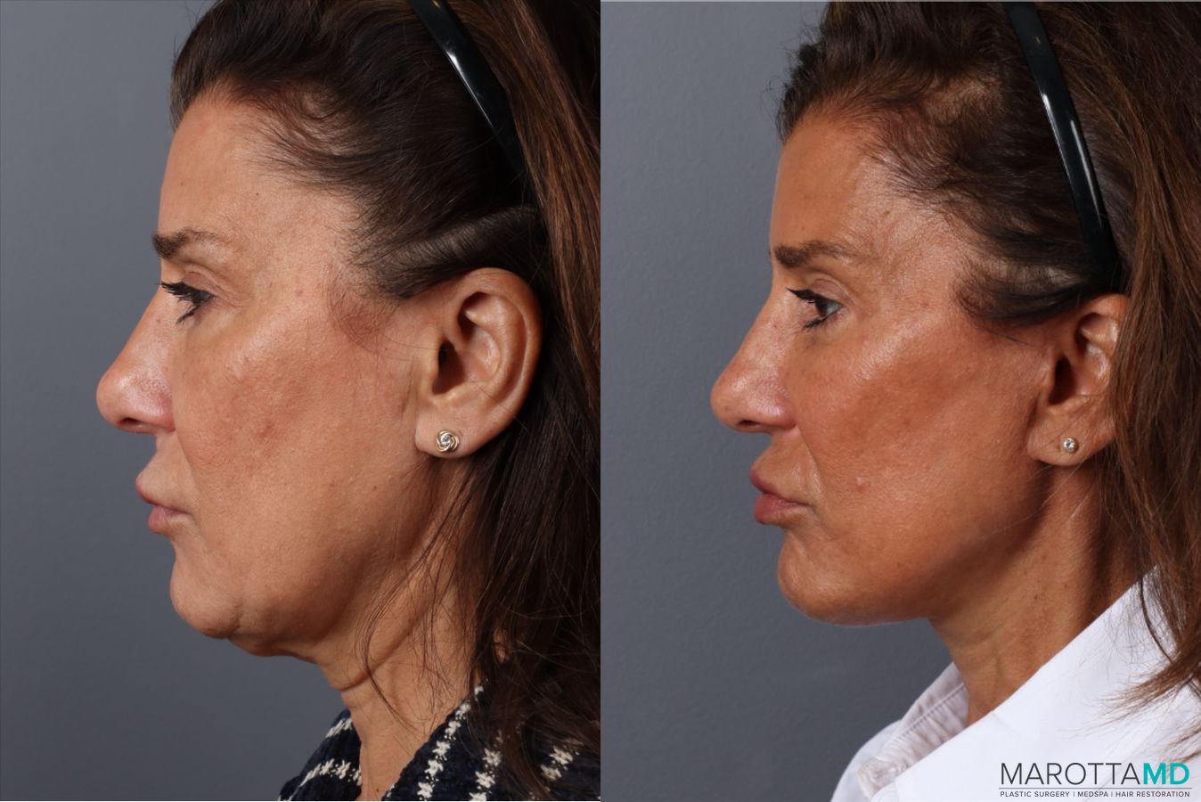 Before and after Blepharoplasty Lower case 49878 - Angle 2