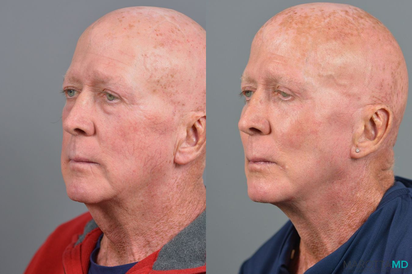 Before and after Blepharoplasty Lower case 7110 - Angle 2