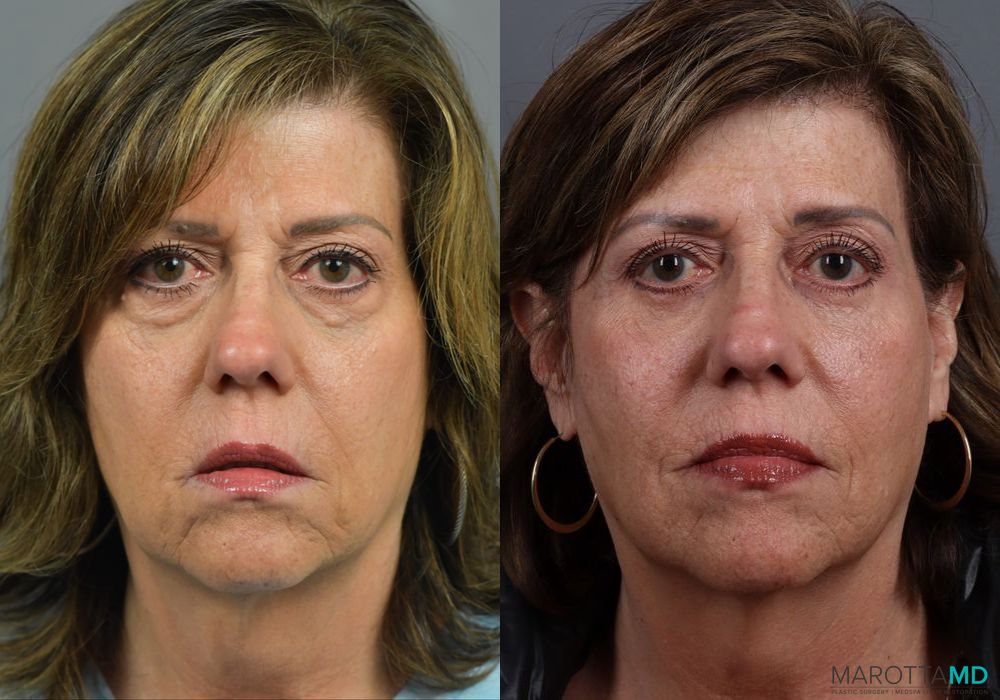 Blepharoplasty Lower - Case 938