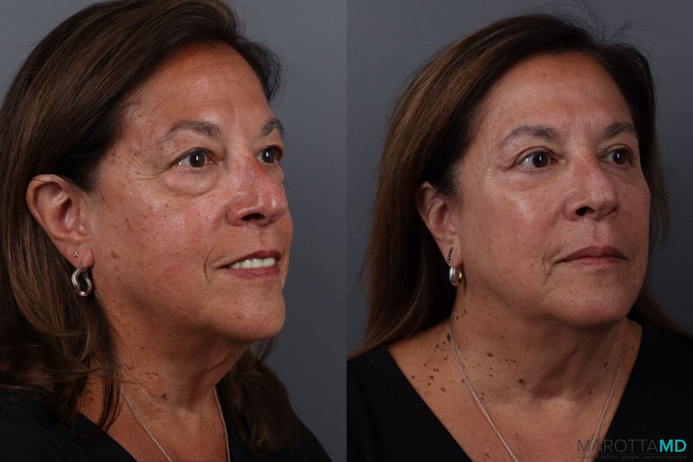 Before and after Blepharoplasty Lower case 19701 - Angle 2
