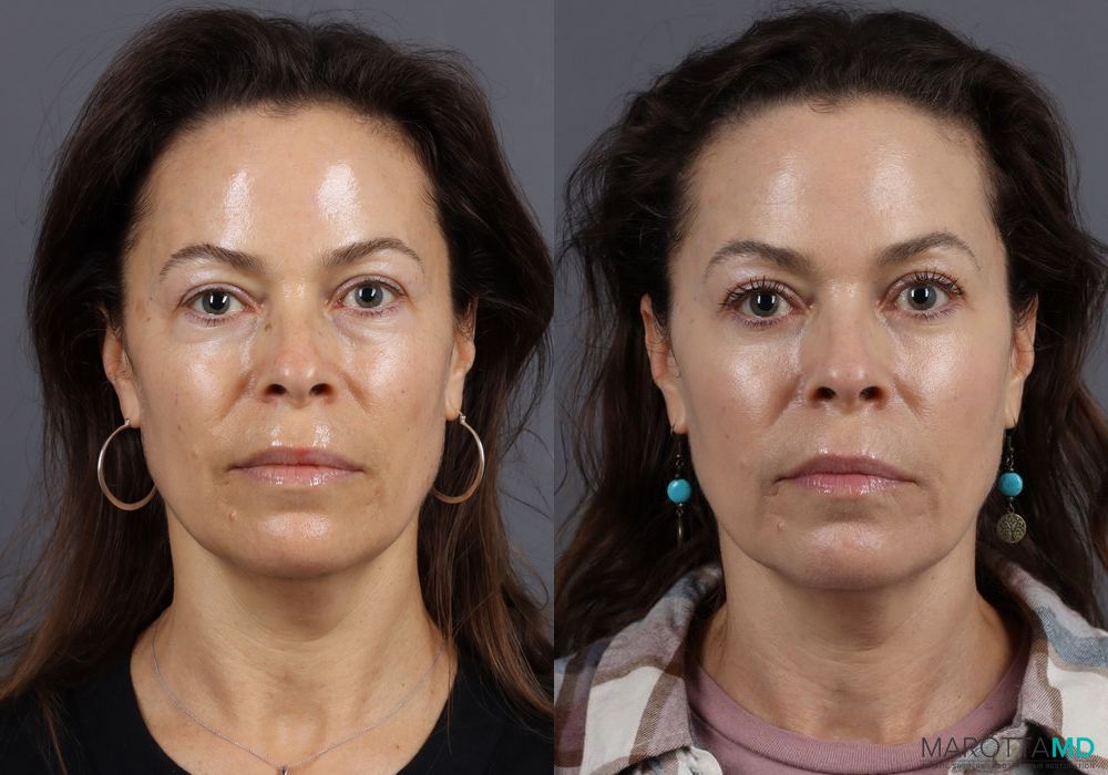 Before and after Blepharoplasty Lower case 7099