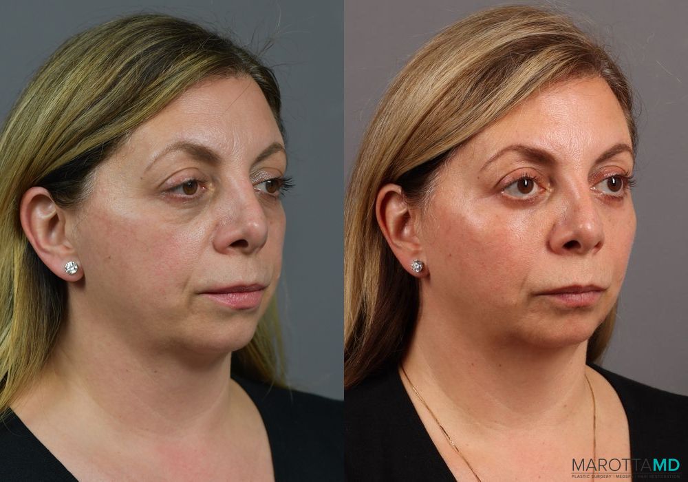 Blepharoplasty Lower - Thumbnail 2