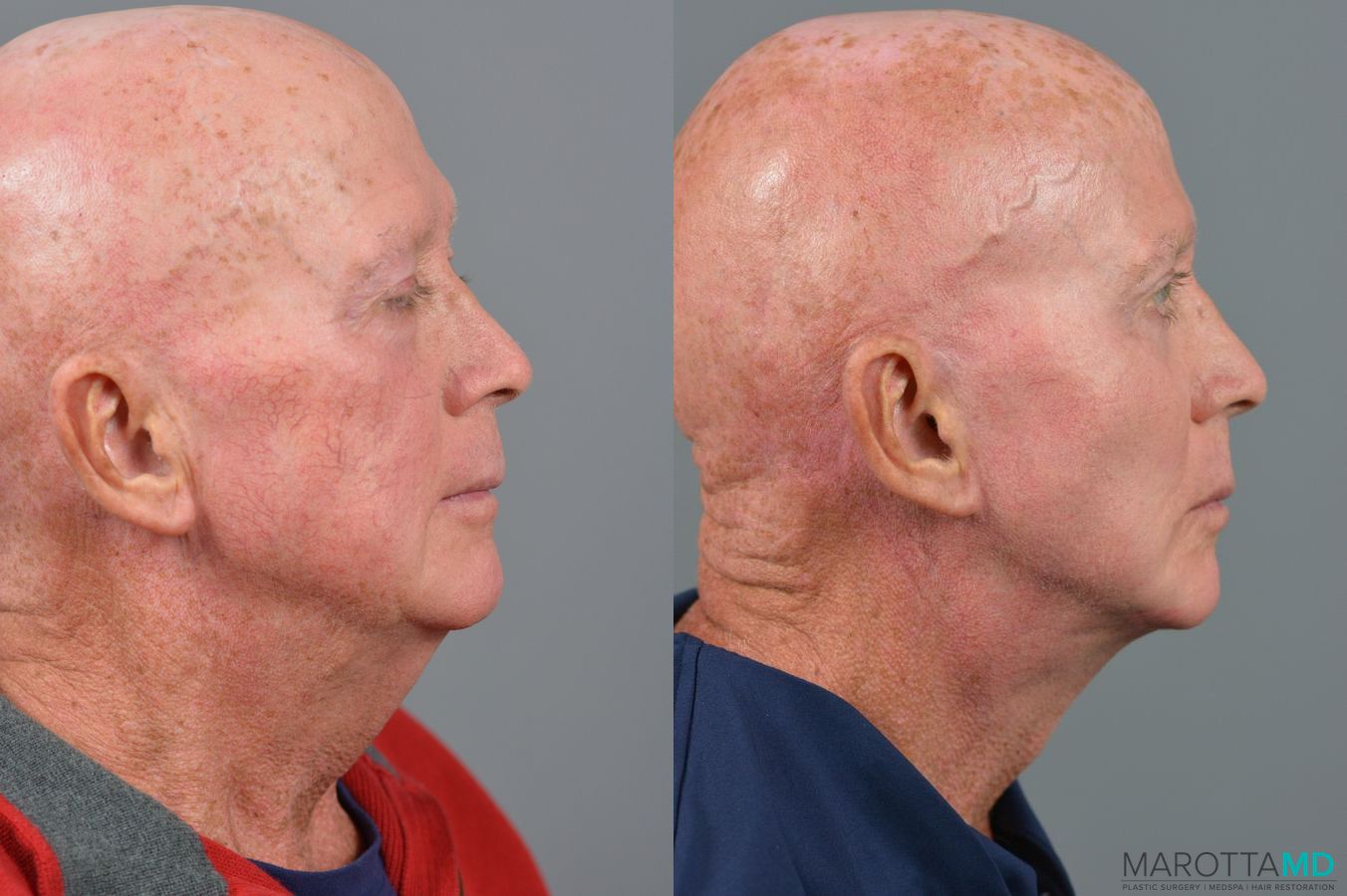 Before and after Blepharoplasty Lower case 7110 - Angle 4