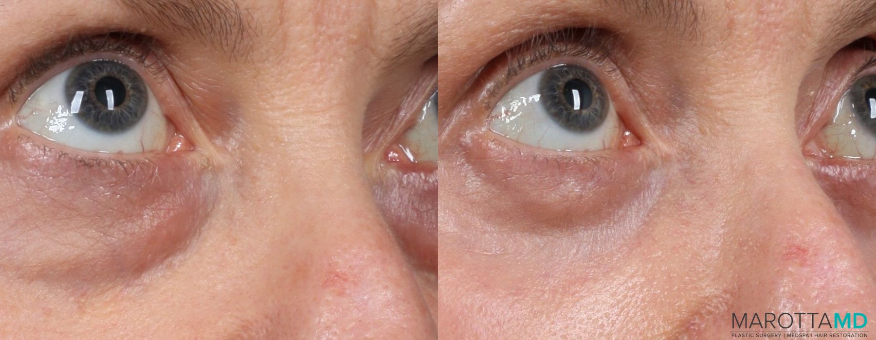 Before and after Blepharoplasty Lower case 7093 - Angle 3