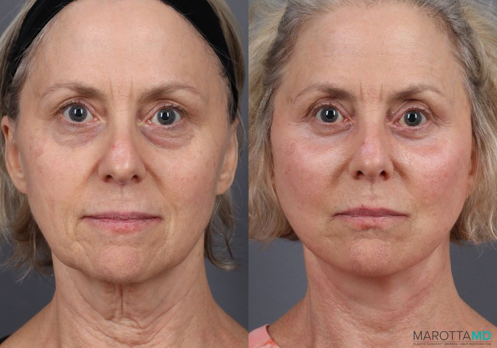Before and after Blepharoplasty Lower case 7093 - Angle 4