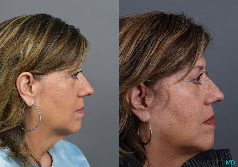 Blepharoplasty Lower - Thumbnail 3