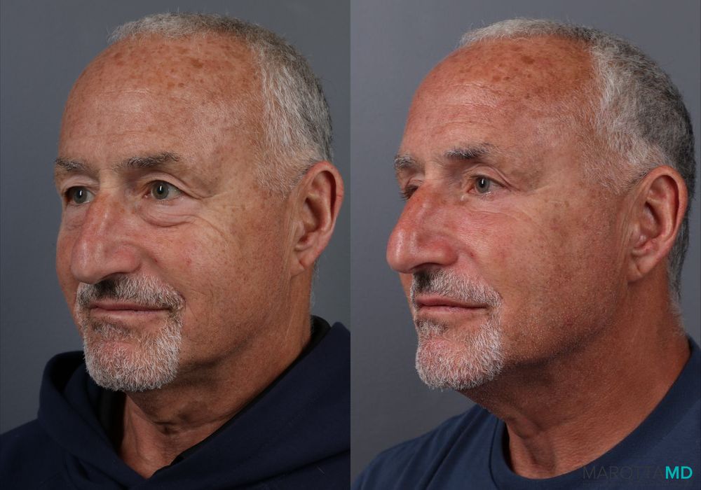 Blepharoplasty Lower - Thumbnail 3