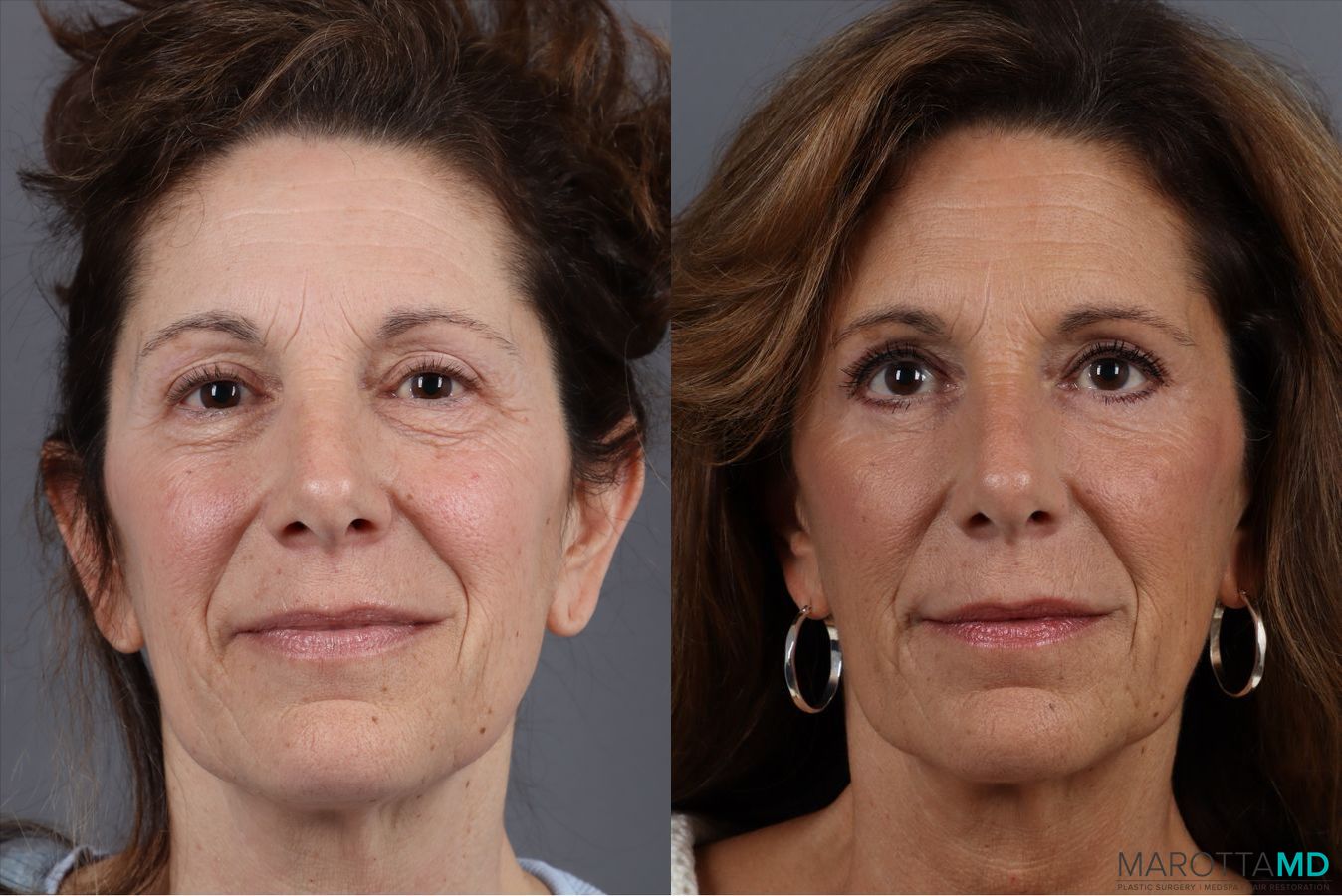Before and after Blepharoplasty Lower case 41924