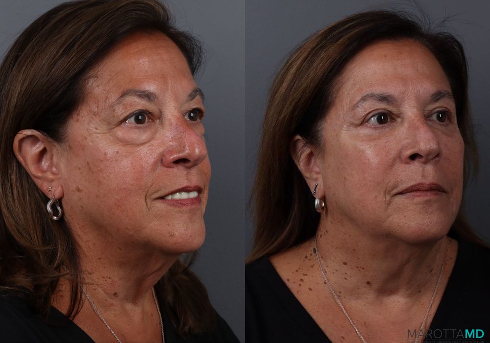 Blepharoplasty Lower - Thumbnail 2