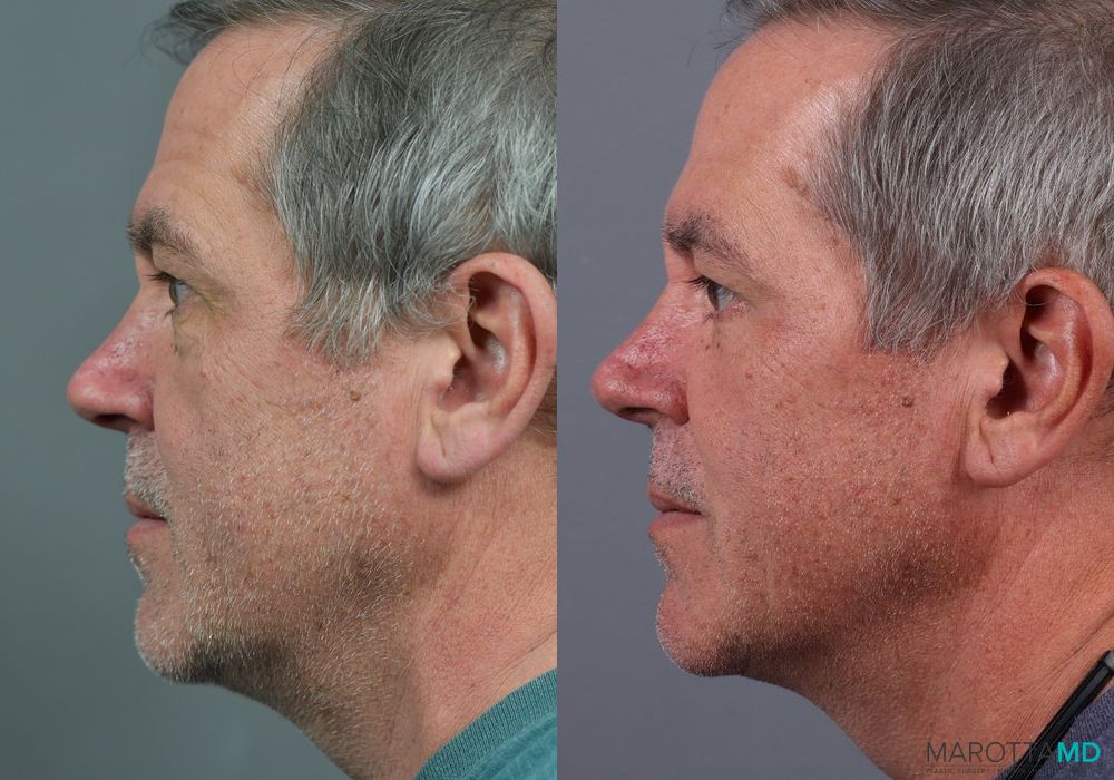 Before and after Blepharoplasty Lower case 7109 - Angle 5