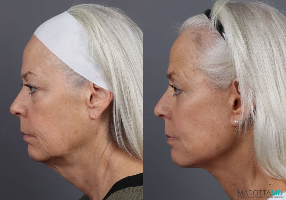 Before and after Blepharoplasty Lower case 7102 - Angle 5