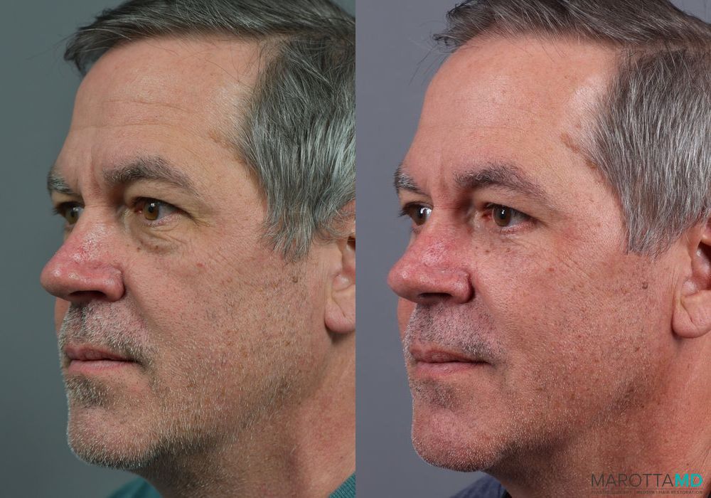 Before and after Blepharoplasty Lower case 7109 - Angle 4
