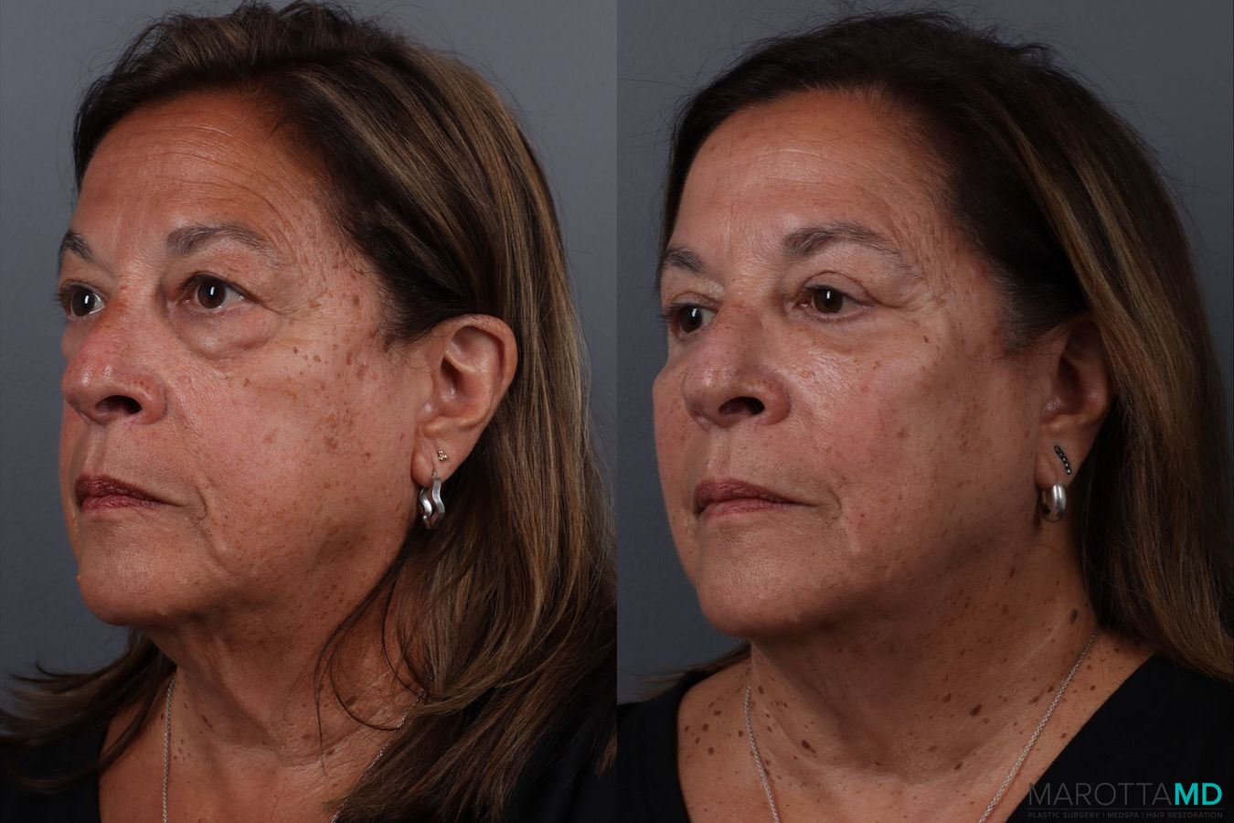 Before and after Blepharoplasty Lower case 19701 - Angle 4