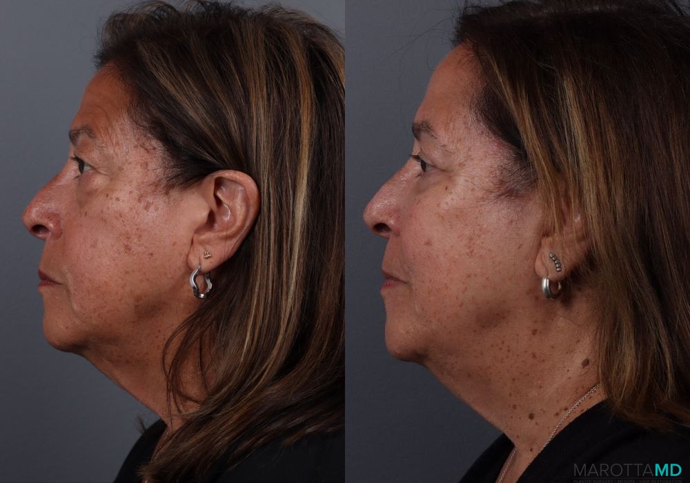 Blepharoplasty Lower - Thumbnail 5