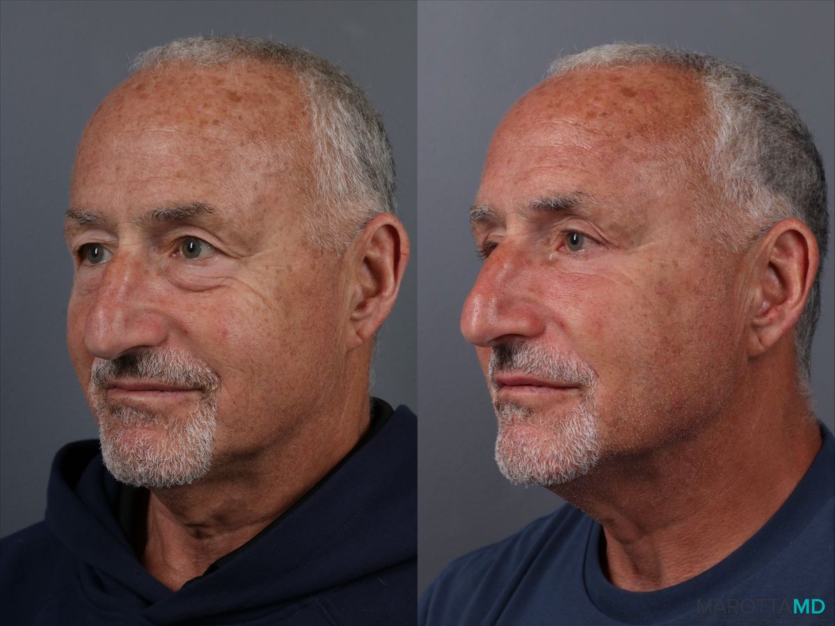 Before and after Blepharoplasty Lower case 17403 - Angle 3
