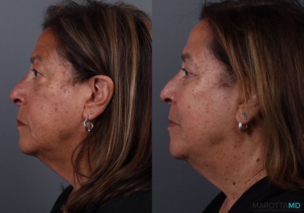 Blepharoplasty Upper - Thumbnail 5