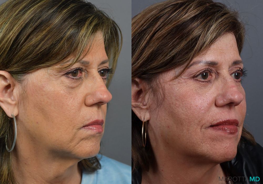 Blepharoplasty Lower - Thumbnail 2