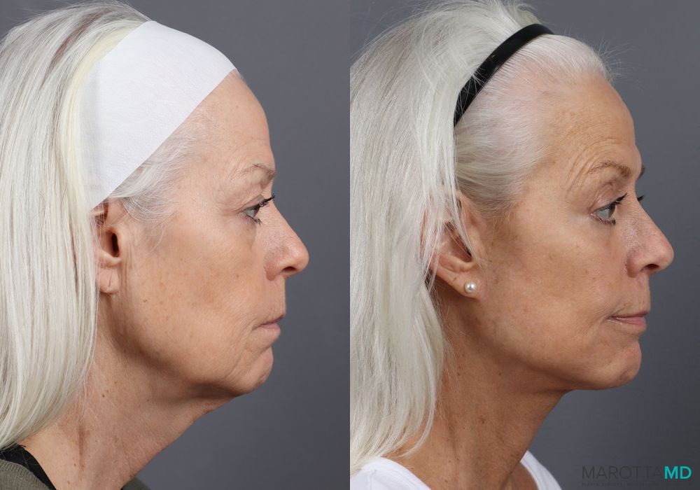 Before and after Blepharoplasty Lower case 7102 - Angle 3