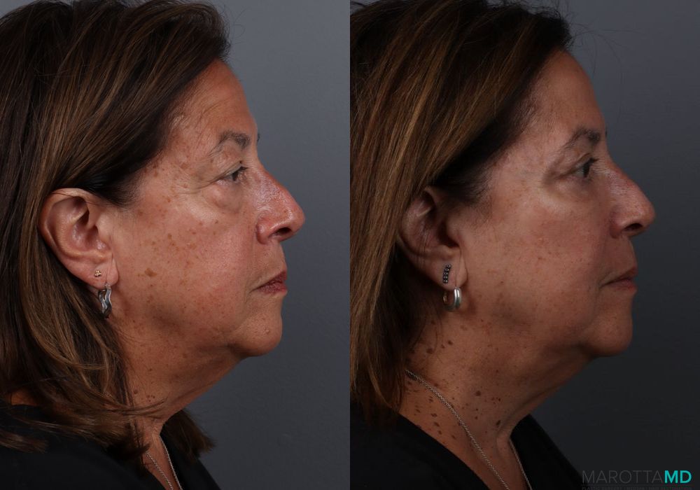 Blepharoplasty Lower - Thumbnail 3