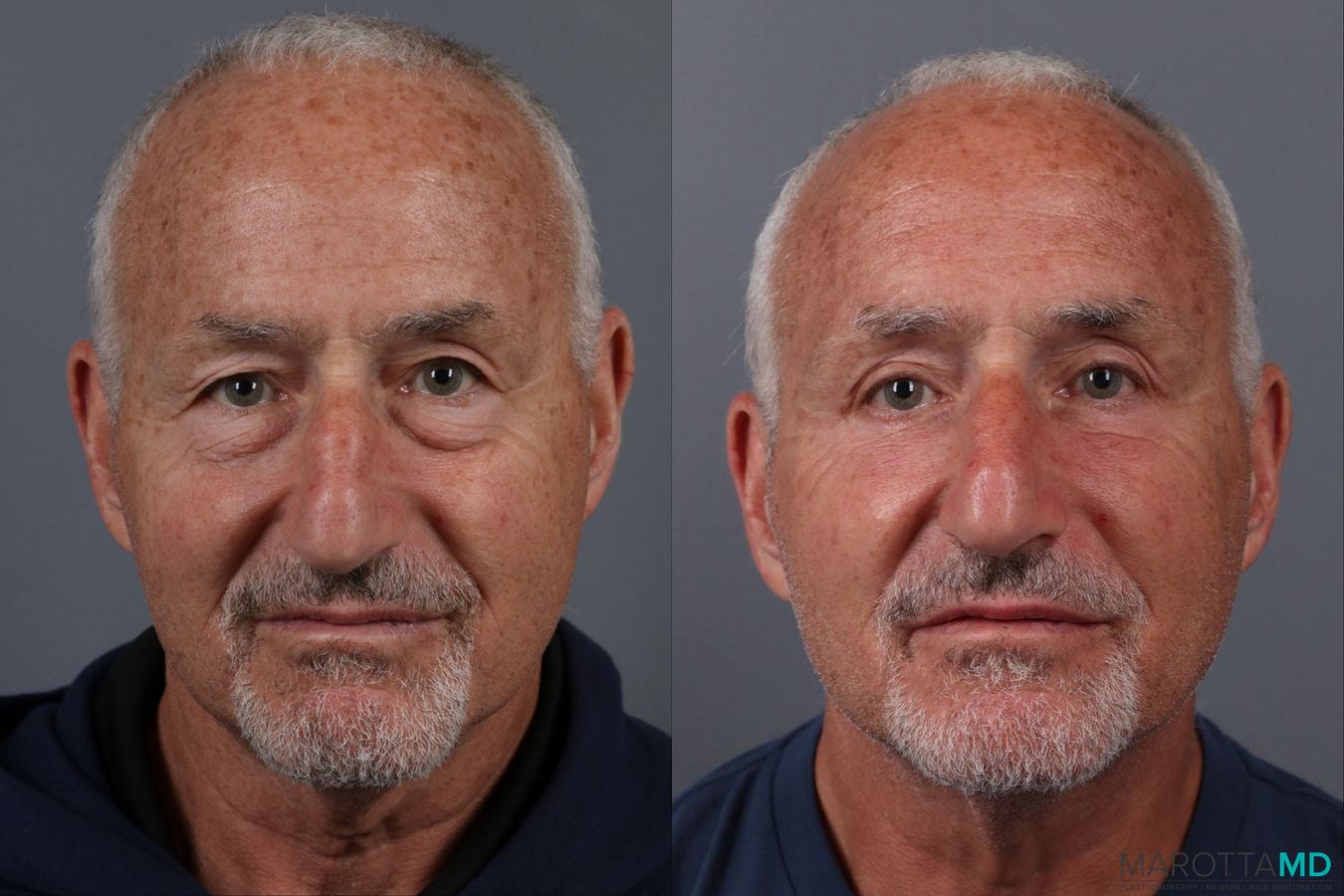 Before and after Blepharoplasty Lower case 17403
