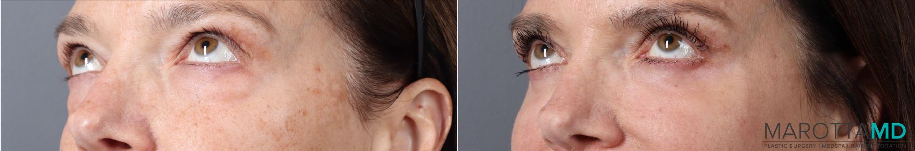 Before and after Blepharoplasty Lower case 43416 - Angle 2