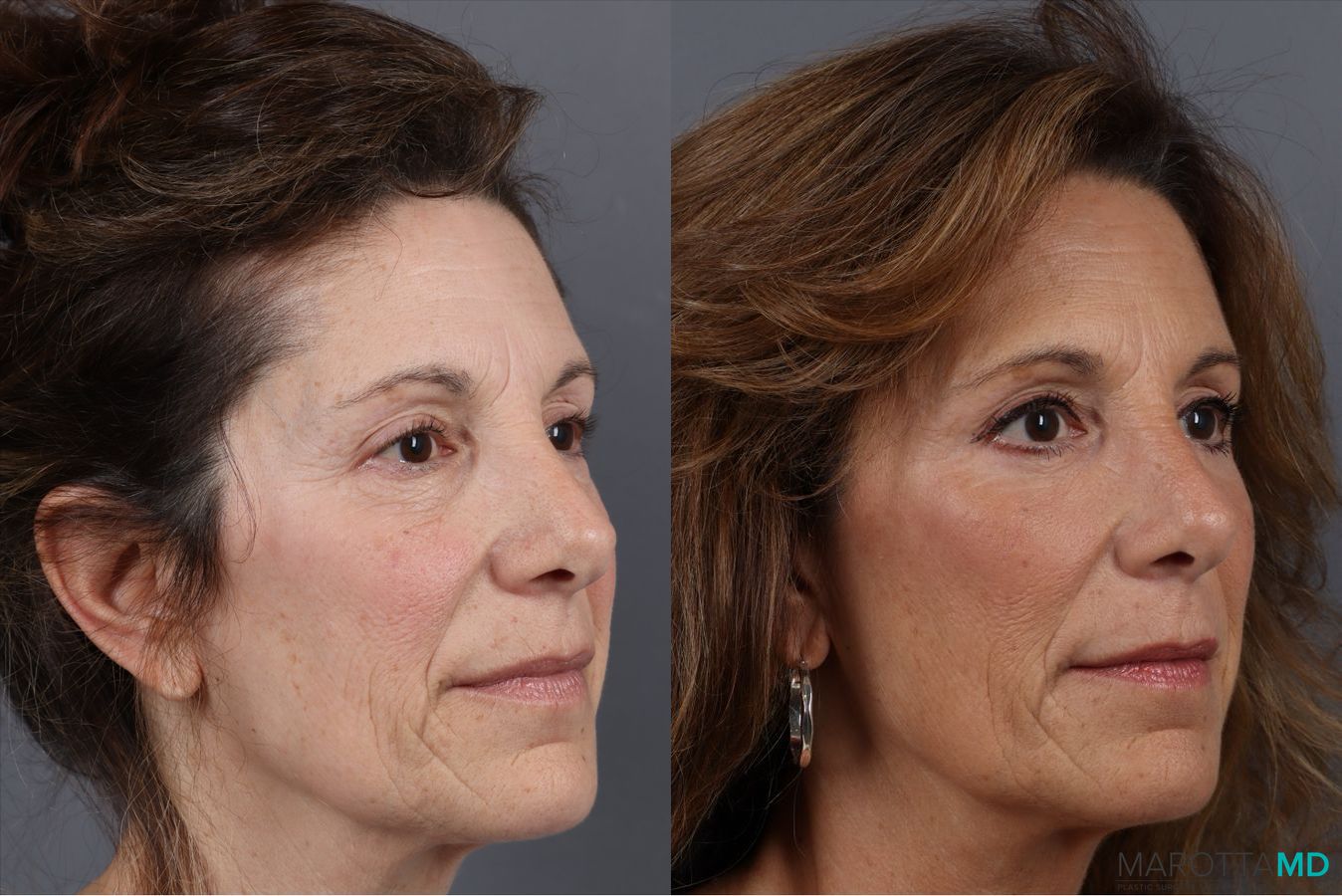 Before and after Blepharoplasty Lower case 41924 - Angle 2