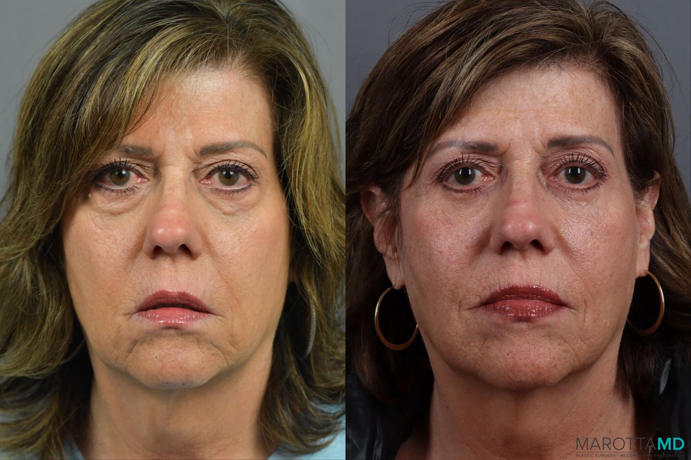 Before and after Blepharoplasty Lower case 21370